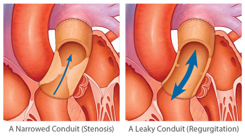 Symptoms of Pulmonary Valve Conduit Failure